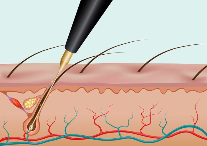 Electrolysis vs. Other Hair Removal Methods: What You Need to Know 1