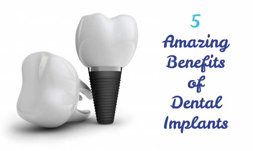 5 Amazing Dental Implants Benefits