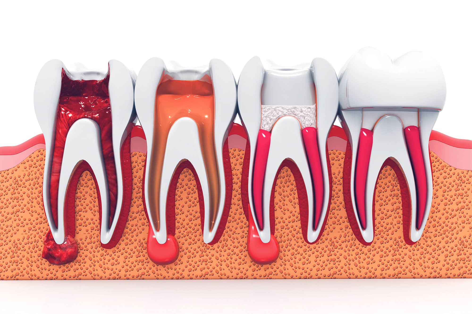 Root Canal Treatment in Berwyn IL