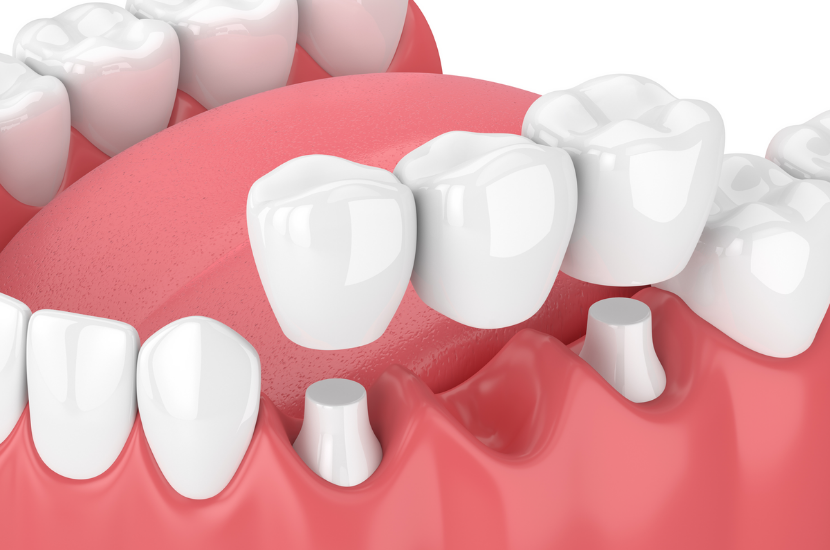dental bridges