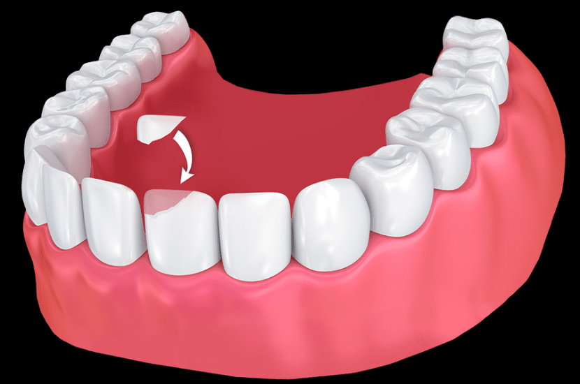 dental bonding