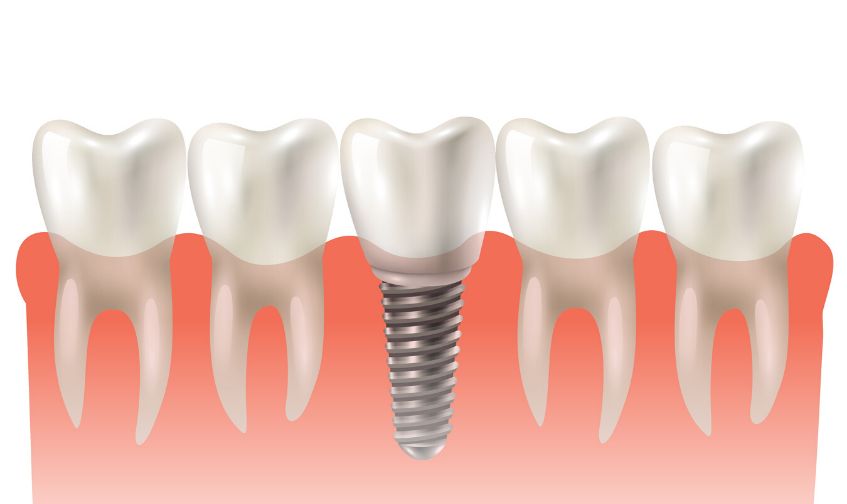 dental implants