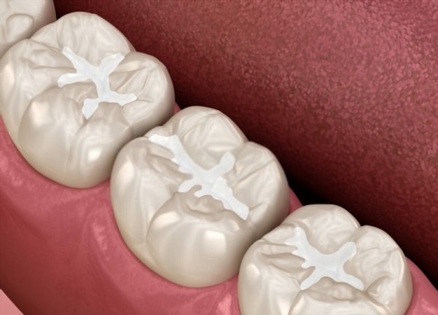 Dental Sealants
