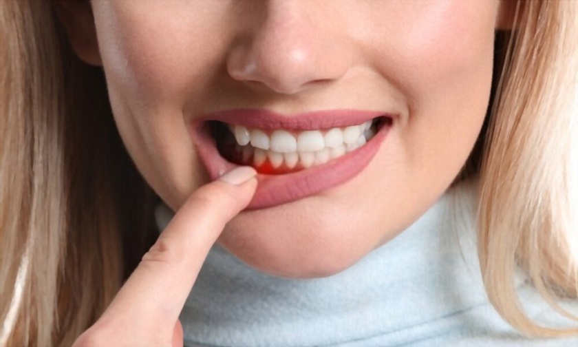 Gum Disease