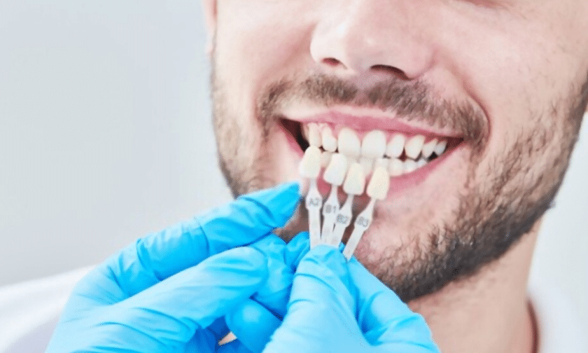 Dental Veneers