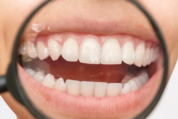 fluoride treatment in berwyn