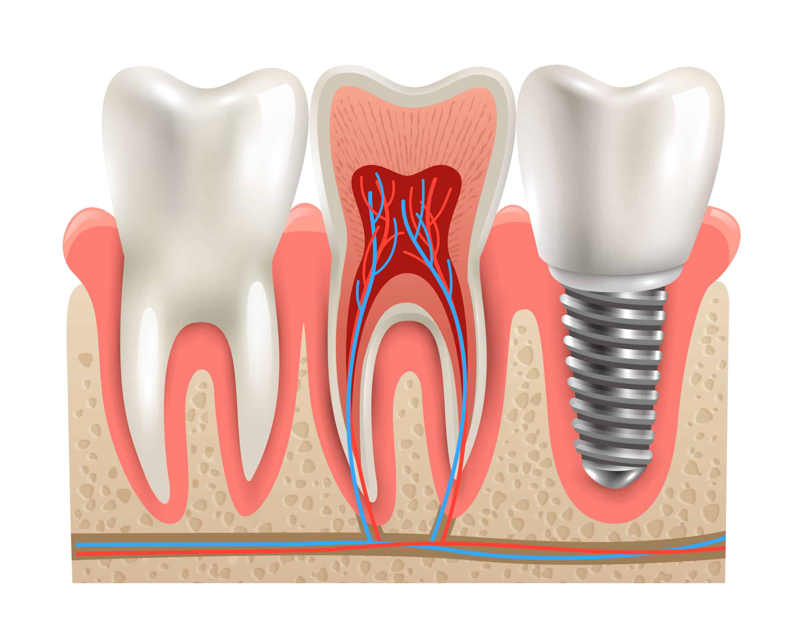 root canal therapry in berwyn il, berwyn dental connection