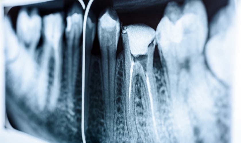 root canal therapy in berwyn il
