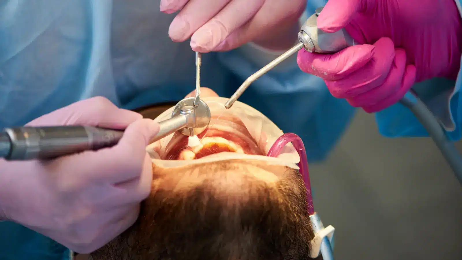 Bonding for Beautiful Smiles in Berwyn - enhance your confidence