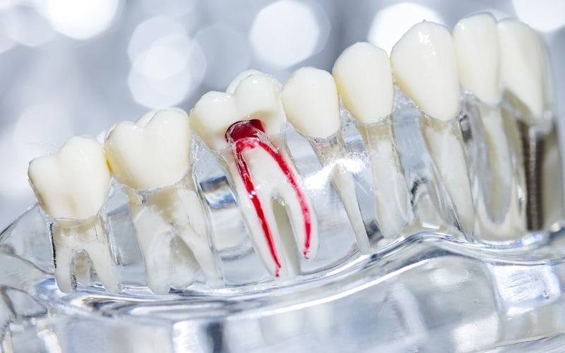 root canal warning signs you shouldnt ignore