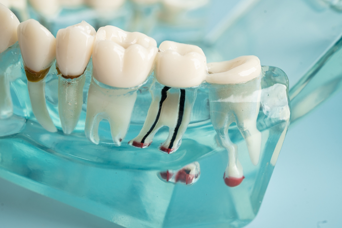 root-canal-treatment-in-Berwyn