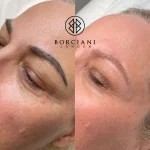 14D52AAE-6B4A-40A1-919C-B7ABE5758833_1_105_c Microblading Removal Laser