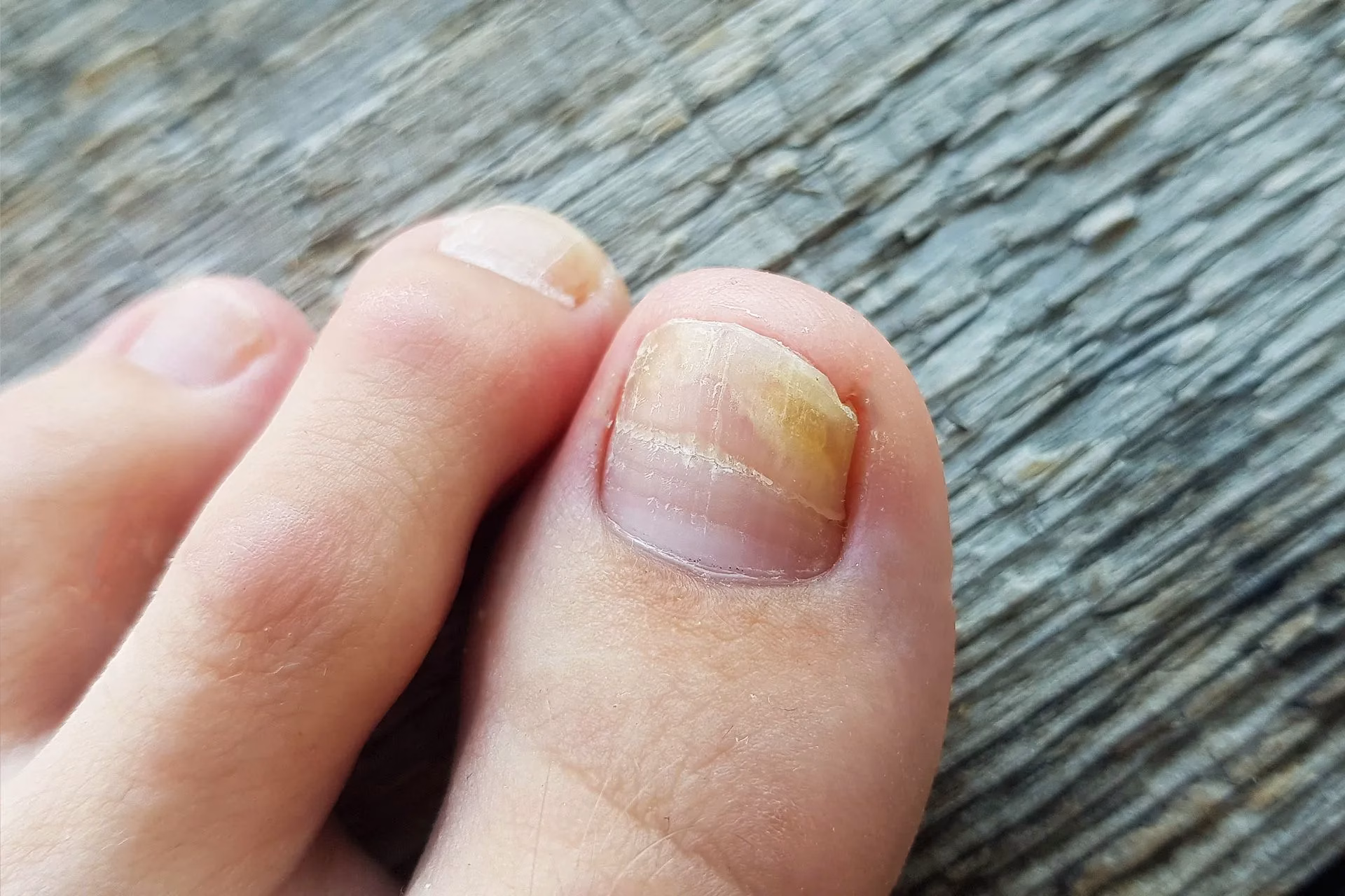 210707-The-Foot-Practice-Prevent-Toenail-Fugus.jpg nail fungus