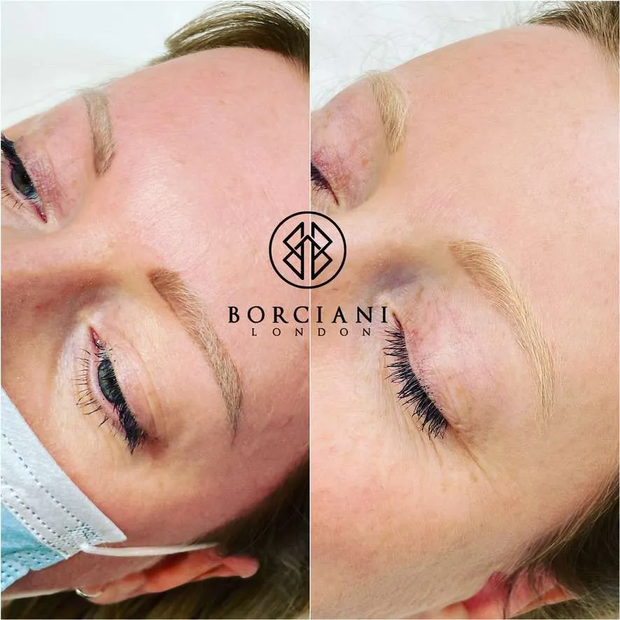 Permanent Makeup Removal in London - What are your options? 10 Microblading removal before and after