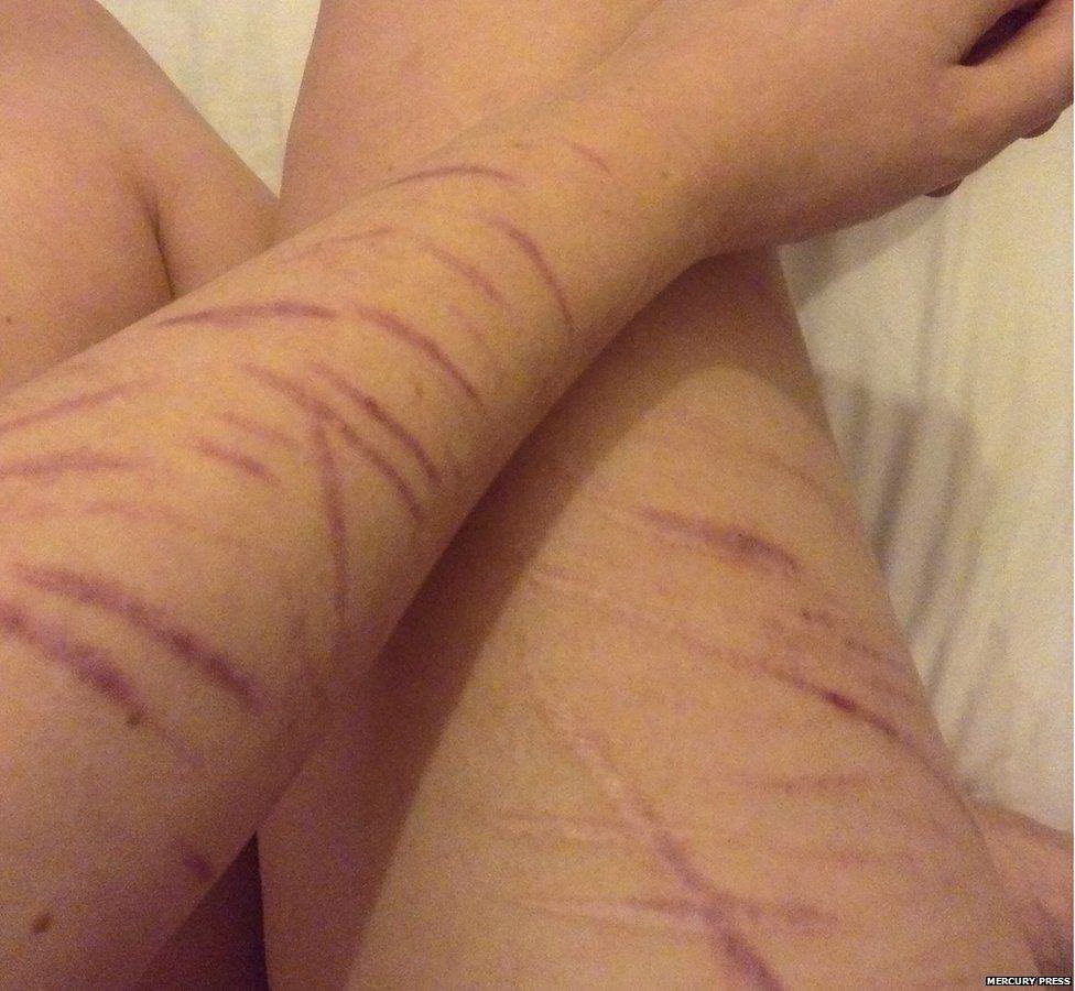 _88814885_mpm_girl_refused_alcohol_over_scars_06 88814885 mpm girl refused alcohol over scars 06
