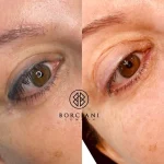 9EDC1444-8D60-47A9-89FA-CACCB7F102CC_1_105_c Eyeliner Tattoo Removal