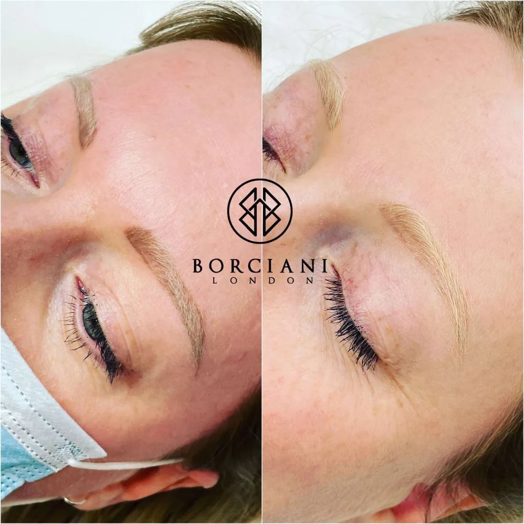 Permanent Makeup Removal in London - What are your options? 4 Saline permanent makeup removal in progress