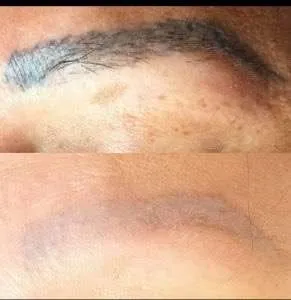 Permanent Makeup Removal in London - What are your options? 13 Laser removal equipment