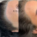 IMG_3633 Permanent Makeup removal