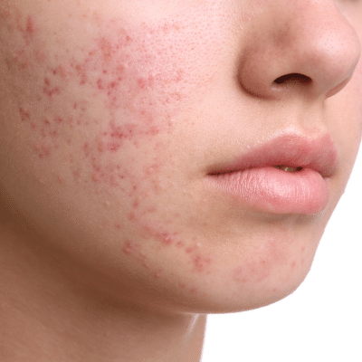 PenDerm-Acne-101-Blog.bak Acne