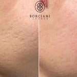 acne3 acne3