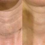 neck1 Plasma Lift neck treatment before and after