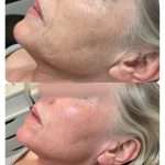 04B57B71-F049-42B6-A548-B22D6ED9181B_1_105_c Skin Rejuvenation and tightening