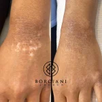 054FD639-AF40-4DEC-BF43-27A410440764 Scar Treatment London