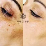 08D5ED0A-F645-4970-9480-51245E7DB311-400x284 Pigmentation Treatment