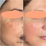 0E6BF3C7-3447-4063-ABED-83F8B346F2D8_1_105_c Pigmentation removal