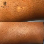 24BB918E-7209-4E4D-8A06-9339D3372345 scar camouflage before and after
