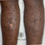 37366BB6-770A-4E70-AEA6-0D4B0F6183C9_1_105_c Scar camouflage before and after