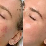 3851A366-5D5F-4C58-BAD8-30FBF495D9CF-1-400x284 Breakouts and pigmentation