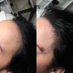 3F7F1D27-6FFB-486D-8B41-4E8787DAC60D Hair Loss Treatment