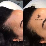 42F31801-2D04-4FA3-93AB-9495E9E88937 Hair Loss Treatment