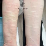 4D620150-0F9D-4D43-85B4-691A04AD6039_1_105_c-1 self harm scar before and after CO2