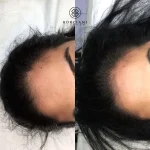 5A7F392E-E642-4863-9528-E5B745F4A475 Hair Loss Treatment