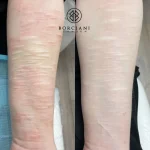 5A9A8A56-FA40-4BE8-866C-1D462CD804BB_1_105_c self harm scar CO2 before and after