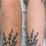 5Zpxa self harm scar before and after Co2