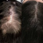 60C7E794-388E-432B-8CD2-D102EFFD391F Hair Loss Treatment