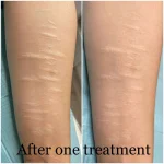 6B71421E-8E68-4824-958E-EB3EB3A28C22_1_201_a Self harm scar before and after
