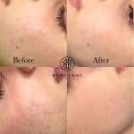 6C8FC599-E530-4D1F-92C1-826751EC0C69_1_105_c Acne Reduction Treamtnent