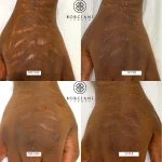7EC83B43-4BB3-4C02-898F-CC0B00105E2B (1) scar camouflage before and after