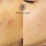 8230D6E1-8D3D-4633-BE15-2E9C04BDE035-400x284 Acne Reduction