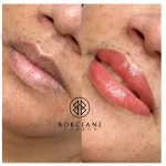 9631DC20-DBFB-410C-BC14-7842AB7EB26D Lip Neutralisation Treatment