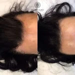 9A553E11-A619-40ED-9A58-A39860A522C2 Hair Loss Treatment