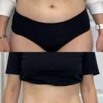 RF Treatment body Tightening and reduction stomach