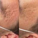 A09BD860-48FC-40E4-BF4F-151FCDBD4C39_1_105_c Acne scar reduction