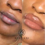 A46953F5-029F-4DB7-BD56-9831DC686050 Lip Neutralisation Treatment