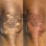 A5F966E3-0D4E-41F6-BA2F-8D0209292472-1 (1) scar camouflage before and after